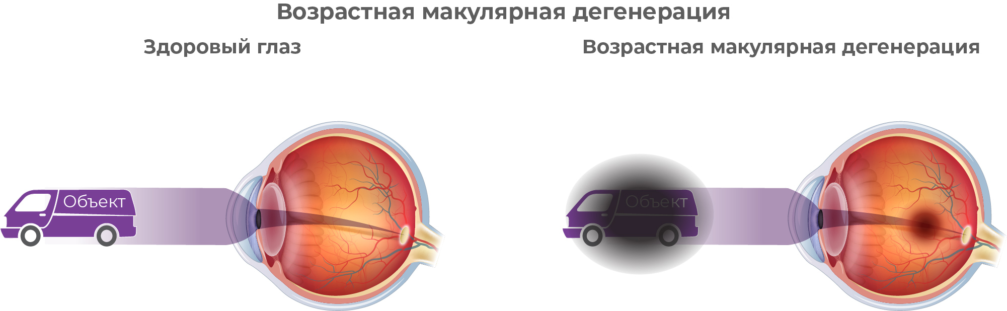 Схема здорового глаза и глаза с заболеванием