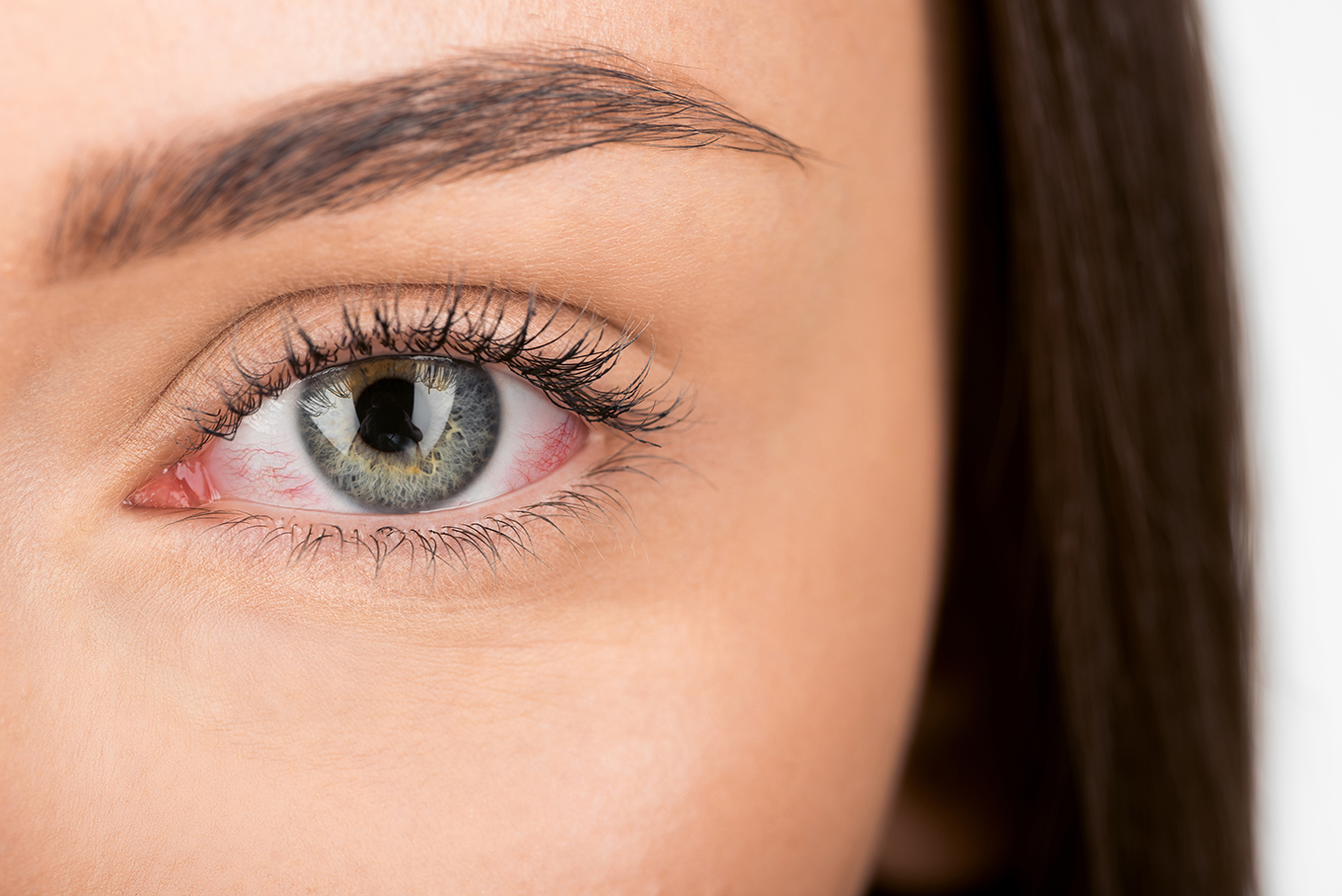 Синдром "сухого глаза"